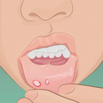 口唇ヘルペスが1日で治る？８つの治す方法が話題に…
