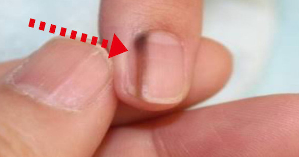 ネイリストがお客さんの爪に黒い線の正体 ただちに病院へ行くように告げた理由とは バズニュース速報
