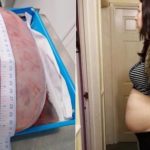 妊婦に見える女性…腹部から摘出されたのは直径40cmの巨大腫瘍だった…