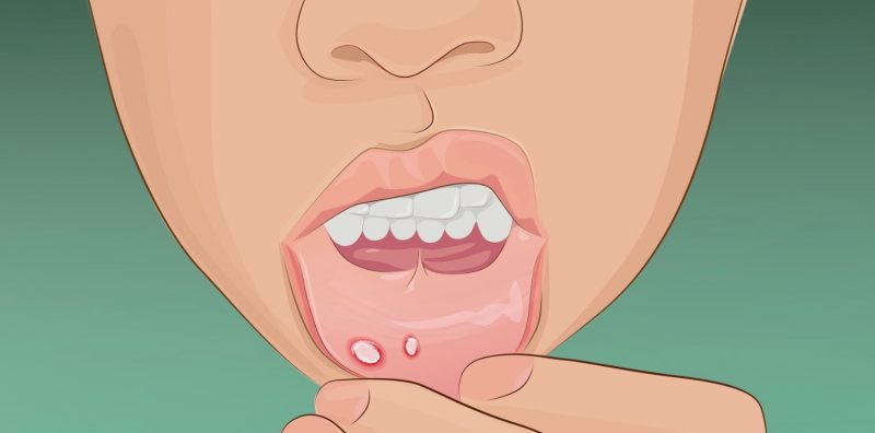 唇が教えてくれる体の状態8選 唇が乾燥したり吹き出物がでたりするのはなぜ バズニュース速報